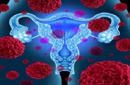 فیبروم و آندومتریوز احتمال سرطان تخمدان را بیشتر می کند