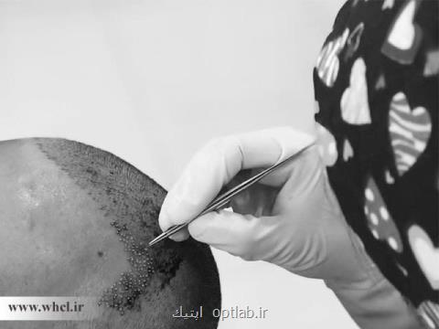 چند توصیه مهم بعد از كاشت مو