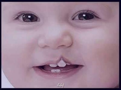 علل ابتلاء به یكی از شایع ترین بیماری های مادرزادی سر و گردن